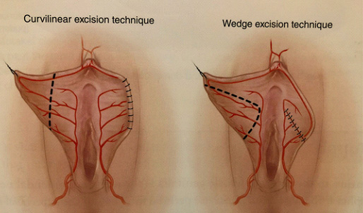 Labioplastyka technika Wedge