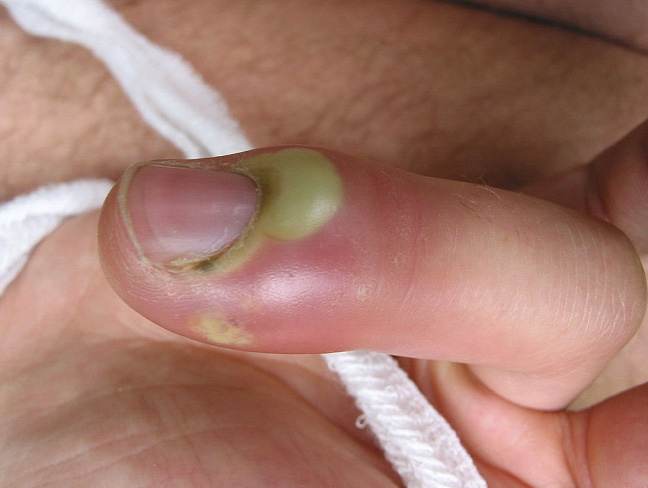 leczenie wrastających paznokci